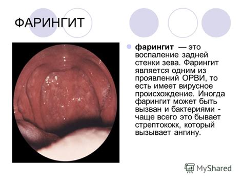 Презентация на тему: "ЛОР-болезни LARINGS OTOS RINOS. Отит катаральный ...
