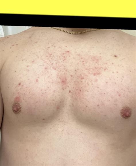 [Routine Help] Chest Acne Help : r/SkincareAddiction