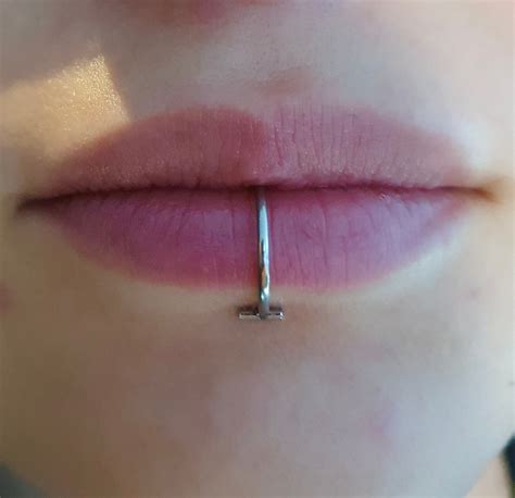 Vertical Labret Scar