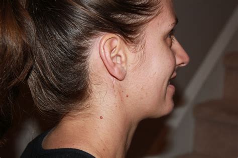 I've got a what? The journey of a parotid tumor.: Parotid surgery ...