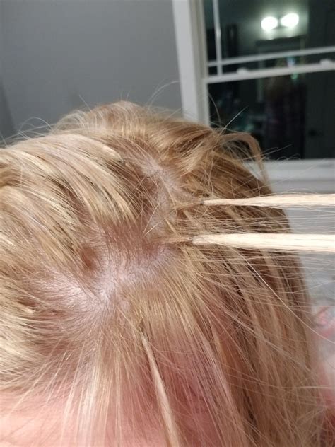 Do I Have Frontal Fibrosing Alopecia at Lauren Blackwell blog