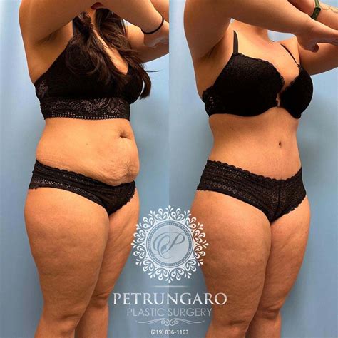 Tummy Tuck & Lipo 360 | Petrungaro Plastic Surgery