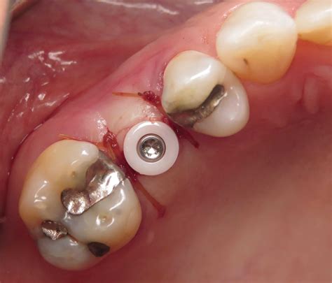 Ceramic Dental Implants Where Aesthetics Matter - Dentistry Today