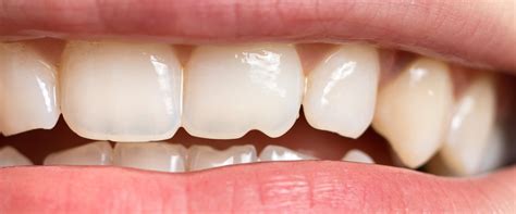 broken  severely damaged teeth   treatment