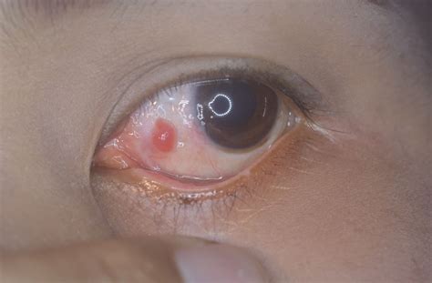 syringoma condition  treatment