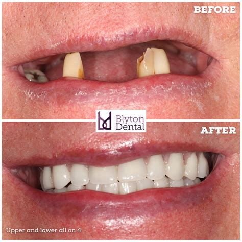 Upper and lower all on 4 — Blyton Dental