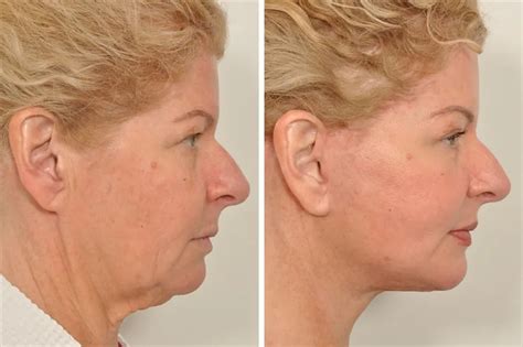 Facelift Before and After Photos | Dr. Benjamin Paul