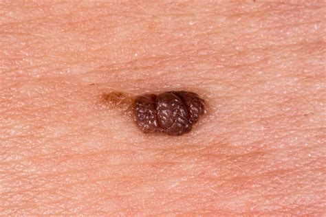 warts symptoms  types  pictures treatment tua saude