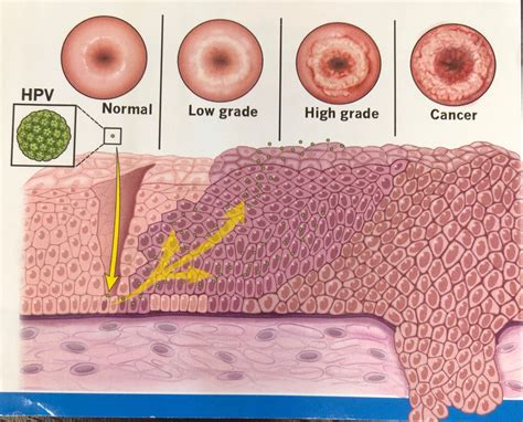 What Does An Abnormal Pap Smear Mean - vrogue.co