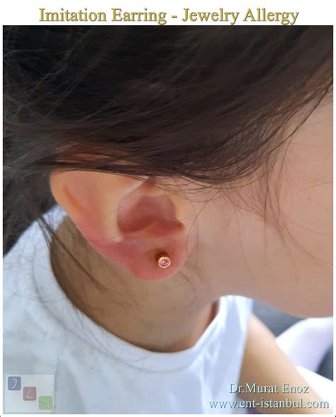 Imitation Earring - Jewelry Allergy