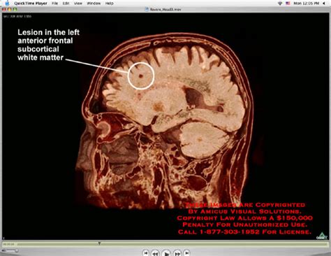 brain lesions   brain lesions