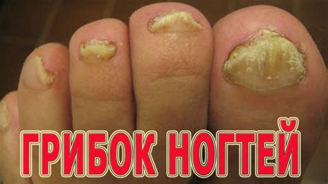 ★Эффективные средства от грибка ногтей на ногах. Комплексная схема ...