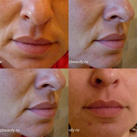 Носогубные складки — vzbeauty.ru