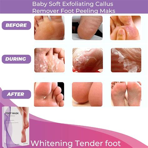 Pairs Exfoliating Foot Peel, Peeling Away Calluses and Dead Skin Cell