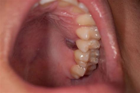 Mucosal Lentiginous Melanoma