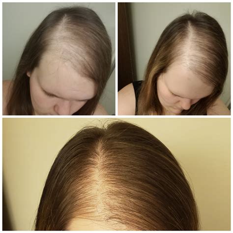 Male And Female Baldness _ Pattern Hair Loss – HEQXD