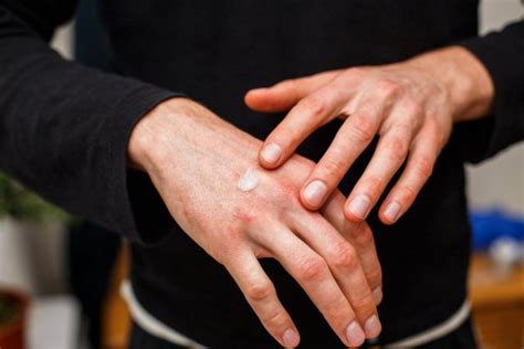 Дисгидротическая экзема: особенности ее лечения | MedAboutMe