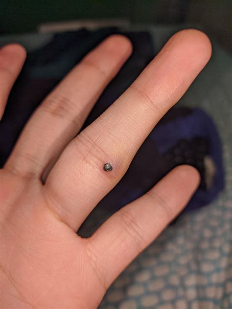 IS THIS A NODULAR MELANOMA? : r/Melanoma
