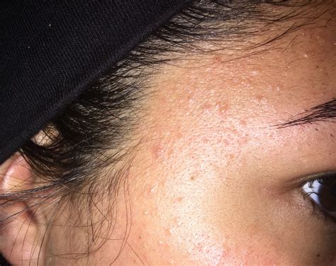 Malassezia Pityrosporum Folliculitis Treatment