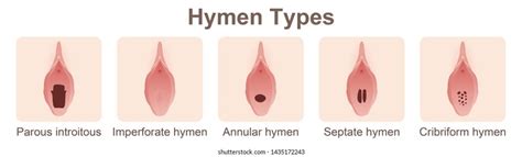 types hymens medical vector illustration