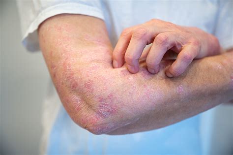 Eczema vs. Allergic Reaction: How to Tell Which Is Which