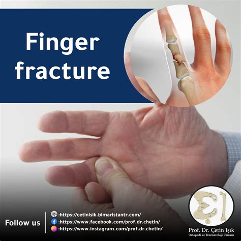 broken finger; Diagnosis and treatment methods - Dr. What's wrong with you?
