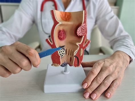 Especialidade Que Cuida De Hemorroidas - 5