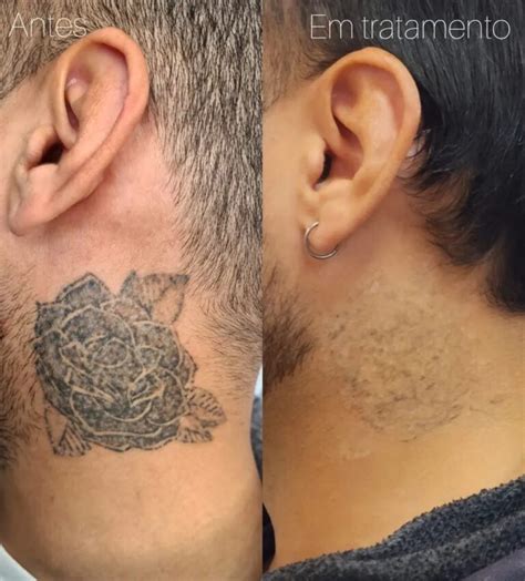 É Normal A Tatuagem Desbota Na Cicatrização - Cicatrização da Tatuagem: Conheça as três fases e o que pode ocorrer