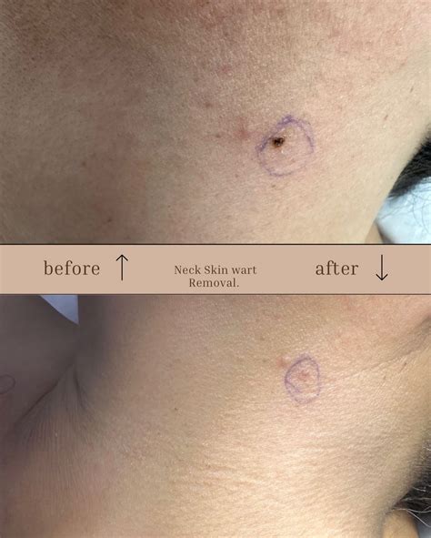 Drtabinda_aesthetics - Plasma pen treatment for skin tags , small lumps