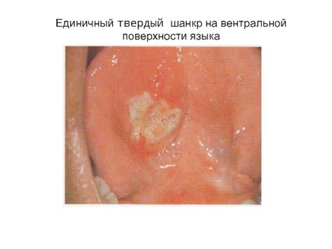 Сифилис, туберкулез