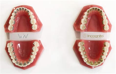 lingual braces voted  dental practice  uk