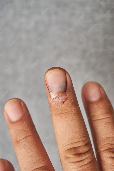 Premium Photo | Injury to the finger of the hand with injury to the