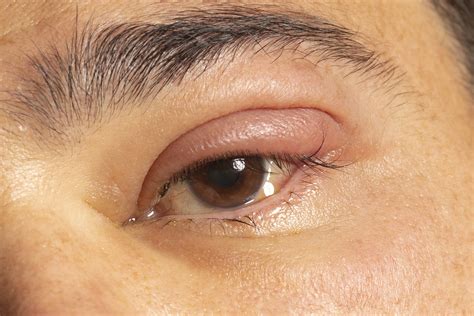 Dealing with Styes - Lumos Vision Care