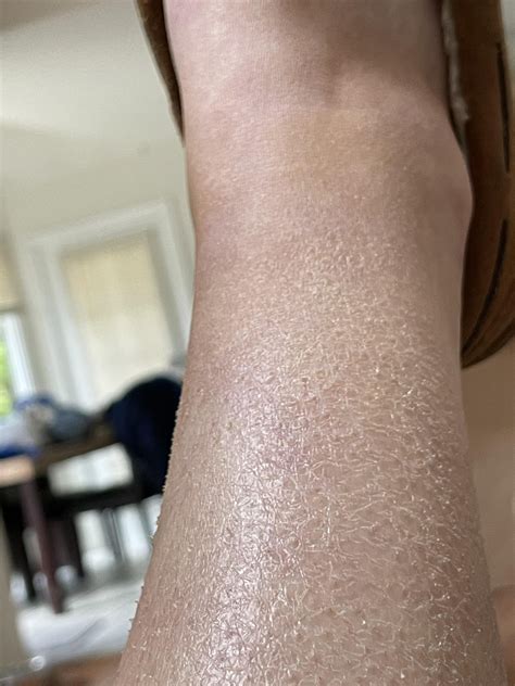 [Skin concern] chronic scaley / flakey dry skin on legs : r ...