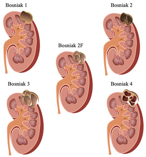 classification  renal cysts