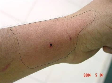 What Are The Symptoms Of A Dog Bite Infection