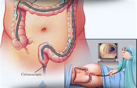 Retirada De Polipos Na Colonoscopia - Como é feita a retirada dos pólipos intestinais