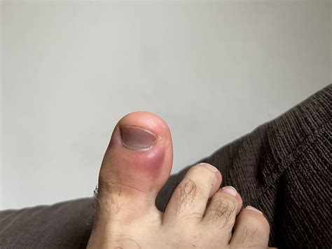 Blood Blister? : r/medical