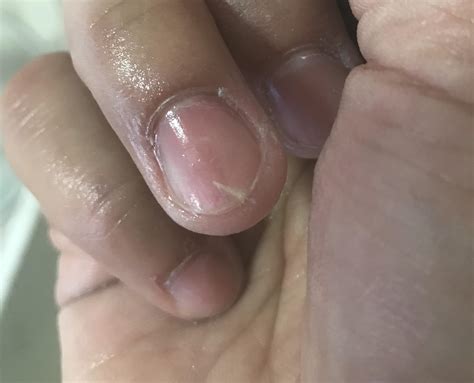 Got a Splinter right under my nail...might hurt less to amputate my