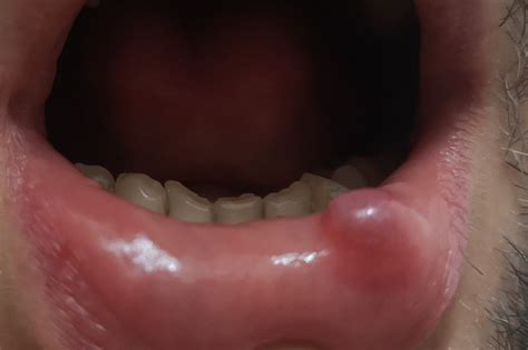 Does this look like a mucocele? : r/askdentists