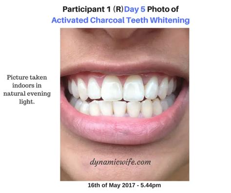 Activated Charcoal Teeth Whitening Experiment -2 REAL Before/After Pics