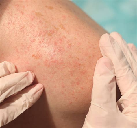 Allergic reaction heat rash | What causes it and how is it treated ...