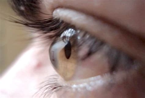 che cose il cheratocono ottica mauro