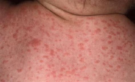What Does Skin Rash From Eliquis Look Like at Charlotte Farmer blog