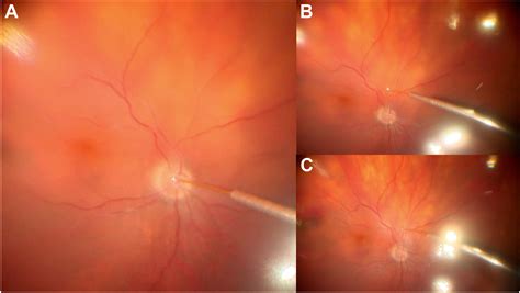 gauge cannula based endodrainage  posteriorly trapped