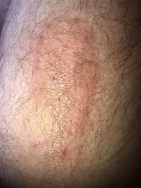 Hair Follicle Infection On My Legs at Vicente Shaffer blog