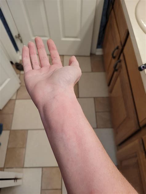 Solar urticaria? : r/urticaria