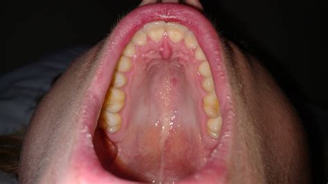 Tiny Bumps On Mouth Roof - A Small Percentage Of People Have A Bump On