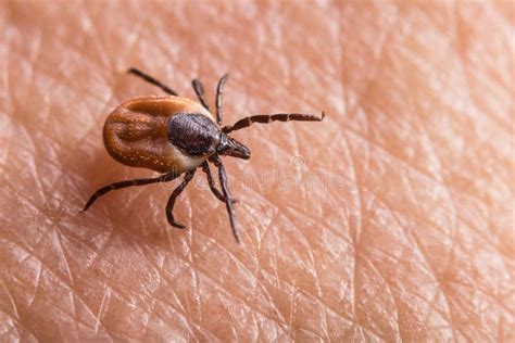 Carrapato Entra Na Pele Humana - Carrapato De Mamona Fêmea Rastejando Na Pele Humana Cor-de-rosa Ixodes ...
