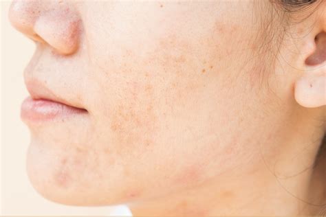 What Are Spots On Your Face at Erminia Heavner blog